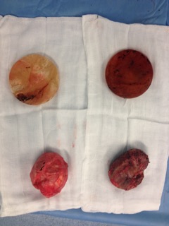  protesis con su capsula grado